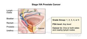 Others have pain or burning during urination, blood in the urine or semen, pain in the back, hips, or pelvis, and painful ejaculation. Definition Of Stage Iv Prostate Cancer Nci Dictionary Of Cancer Terms National Cancer Institute