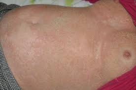 Image result for Pustular Psoriasis