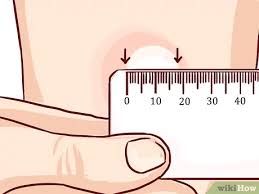 Tuberculosis is an often fatal but now extremely rare and treatable infectious disease. How To Read A Tuberculosis Skin Test 9 Steps With Pictures