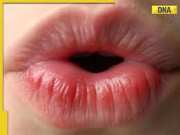 Image result for Lip Cancer