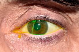 Image result for lesion sclera