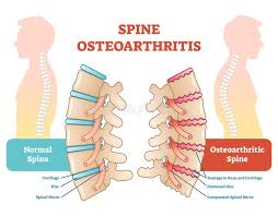Most common type of backbone, used in distribution layer, used in new buildings, sometimes in core layer, can be rack or chassis based. Painful Back Concept Vector Illustration With Human Torso Work Overload Or Sports Injury Stock Vector Illustration Of Male Graphic 111576871
