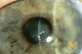 Image result for Eye Foreign Body