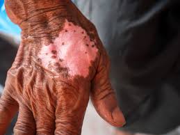 Image result for Leprosy