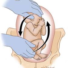 Image result for External Cephalic Version