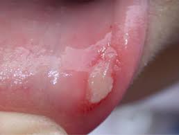 Behcet Disease Dermnet Nz