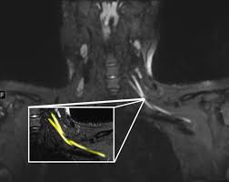 There is mild marrow stress response within the 4th metatarsal proximally. Suffering From Post Covid Pain Or Weakness Request An Ultrasound Or Mri Here S Why