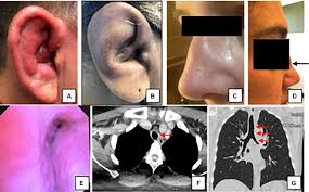 Image result for Relapsing Polychondritis