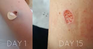 Posted 4 years ago, 8 users are following. Biopsy Healing Progress Melanoma