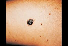 Melanoma pictures to help identify skin cancer. Malignant Melanoma Picture Image On Medicinenet Com
