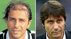 Antonio conte non ha mai confermato di essersi sottoposto ad autotrapianto di capelli. Football Players And Hair Who Had Transplants Who Wears Prosthetics Who Has Resigned
