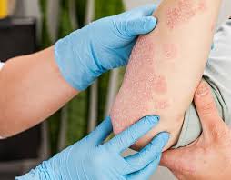 Image result for psoriasis