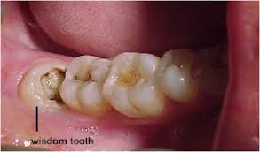 Maybe you would like to learn more about one of these? Complete Information About Wisdom Teeth Wisdom Teeth Dental Emergency Dental Care
