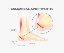 Image result for Calcaneal Apophysitis
