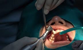 Image result for Tooth Extraction