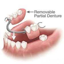 Price Of Dental Prosthesis Dental Aesthetics Dental Implants Cost Dental