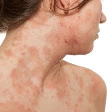 It might look skin coloured, waxy, like a scar or thickened area of skin that's very slowly getting bigger. 18 Common Skin Rash Pictures How To Id Skin Rash Symptoms