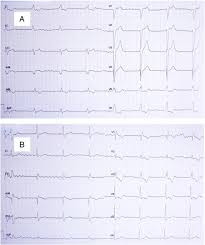 Atrial Fibrillation Complete Atrioventricular Block And Escape Rhythm With Bundle Branch Block Morphologies An Exceptional Presentation Of Lyme Carditis International Journal Of Cardiology