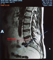 An l5 s1 disc herniation can be incredibly painful and uncomfortable. A Picture Each Day Diagnosis Disk Herniation S1 L5