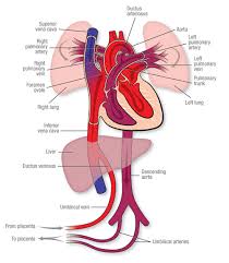 Image result for Delayed Transition from Fetal Circulation