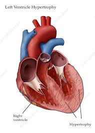 Image result for Left Ventricular Hypertrophy