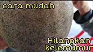 Cara menghilangkan ketombe dengan garam adalah jalan pintas paling tepat bagi kamu yang menginginkan hasil cepat. Cara Hilangkan Kelemumur Dengan Cepat Youtube