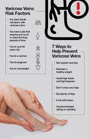Getting Rid Of Varicose Veins: Treatment And Prevention – The Amino Company