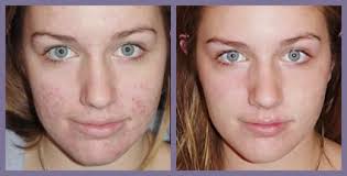 Acne scars before and after home remedies. 7 Top Remedies To Remove Acne Scars 233times