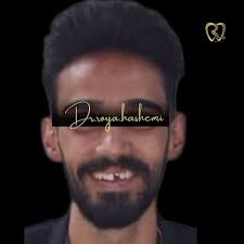 ارتودنسي ثابت بدون كشيدن دندان و اماده سازط فك پايين جهت استقرار ايمپلنت,  توجه فرماييد كه دندان سانترال فك بالا سمت چپ، داراي روكش موقت ميباشد.,  ✍🏻شما هم ميتونين سال اينده زيباتر لبخند بزنين😍, ...