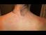 Fungal Folliculitis