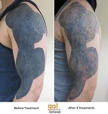 Thankfully, laser tattoo removal is a growing industry, with more advanced lasers being developed to increase treatment why does your tattoo seem to be getting darker after laser removal treatment? Pin En Tattoo Removal In Progress