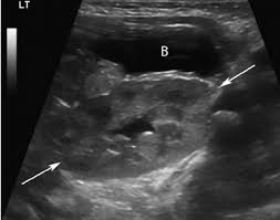 Pelvic Kidney Ultrasound Pelvis Left Parasagittal Plane A Left Kidney Arrows With Incidental Mild Pelvic D Diagnostic Medical Sonography Ultrasound Renal