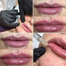 In this article, we'll provide you with a complete guide to lip filler aftercare and help you learn what you should do (and what not to do) after lip filler. Lip Fillers London Lip Enhancement Treatment Clinica Fiore