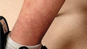 Removing pigmentation from legs : Reticulated Rash On Boy S Lower Extremities Contemporary Pediatrics