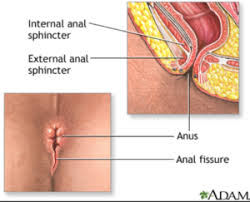 No annoying ads and a better search engine than pornhub! Anal Fissures Are Treatable San Francisco Aids Foundation