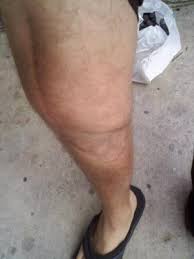 Cancerous cells can deteriorate the bone, and this might sometimes lead to a fracture. Osteosarcoma Physiopedia