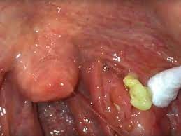 Sore throat and hoarseness that. Meet The Bizarre Reddit Community Obsessed With Digging Out Tonsil Stones On Camera The Independent The Independent