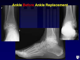 Ankle Arthritis Before Inbone Ankle Replacement Ankle Replacement Ankle Arthritis Ankle