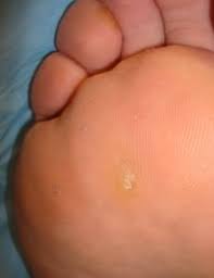 Models of foot function online course: Foot Health Do You Feel Like You Re Walking On Glass You Might Have A Deep Callus Kyforward Com Kyforward Com