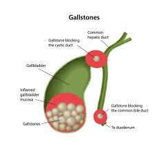 Image result for Gallstone
