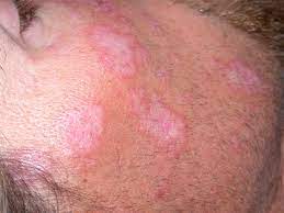 This is a guide on how you can beat lupus boreas in the game genshin impact. Diskoider Lupus Erythematodes Deximed