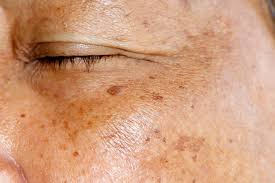 Here are some best treatment for hyperpigmentation can be treated with. How To Treat Hyperpigmentation Age Spots Melasma