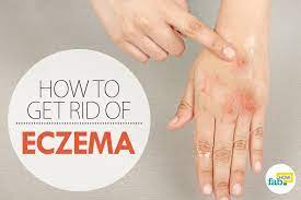 Eczema Is A General Term For Skin Conditions That Result In Discolored Inflamed And Itchy Skin Typically Dry Red Get Rid Of Eczema Eczema Cure Eczema Lotion