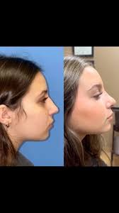 URMC Facial Plastic Surgery (@urmcfacialplastics) • Instagram photos and  videos