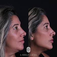 ✨ será mesmo que precisamos de muito produto para um bom resultado?? A  beleza está na harmonia facial! ✨ Neste resultado incrível, utilizamos  apenas 7 ml de preenchimento bem distribuídos, mostrando que