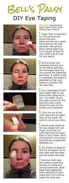 Diy Eye Taping Best And Safest Method For Keeping Eye Closed While Sleeping When Your Face Is Paralyzed With Bell Bells Palsy Eye Tape Bell S Palsy Recovery