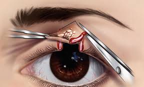 Image result for Eyelid Closure Defect