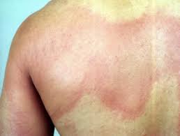Anaphylaxis is when you get severe allergic reactions. Anaphylaxis Dermnet Nz