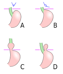 Hiatal Hernia Wikipedia