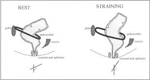 If left untreated, it can cause serious medical problems. Evaluation And Treatment Of Constipation And Fecal Impaction In Adults Mayo Clinic Proceedings